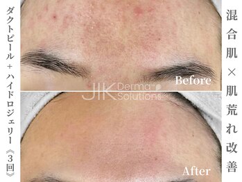 ゼアー(THERE FY.)/名古屋一の症例数☆