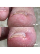 リリ(lili)/巻き爪矯正1回目（右親指）