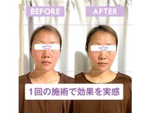 美容鍼で速攻リフトアップ◎糸より鍼で、自然なエイジングケア☆