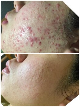 イネスプライベートスペース(Ines)/ニキビケアにも働きかけます