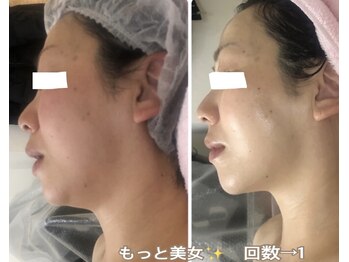 アルページュ(Arpege)/人気1チタニウムLDM白雪アンプル