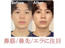 ラプリ 浜松店(Raplit)/隆鼻＋輪郭矯正40分10回