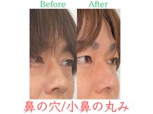 ラプリ 福岡天神店(Raplit)/隆鼻+輪郭・小顔矯正 美鼻/小顔