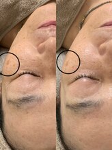 ニコ(25)/ラミピール