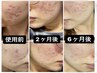 【肌荒れ/10代から続くニキビにお悩みの方へ★】ニキビ肌集中ケアコース