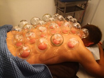 中国鍼灸院 はこしま医針堂/吸玉・カッピング