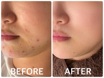 ハーブピーリング 心斎橋/ ハーブピーリングでニキビケア