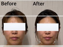 ベール(BEHL)/コルギのBefore After