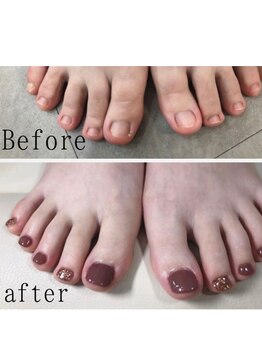 ティアラネイル 宇都宮/フット深爪矯正