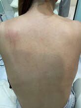 サロンナナジュウ(Salon 70)/背中脱毛で背中ニキビ予防に♪