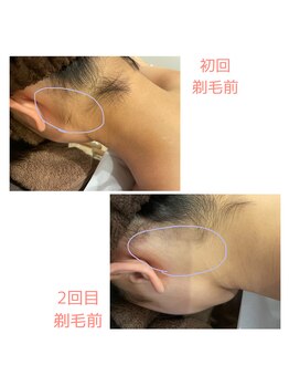 ミスト(MISTO)/【襟足脱毛】