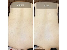 ルナート(Lunart)/ハーブピーリング【背中】