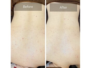 ルナート(Lunart)/ハーブピーリング【背中】