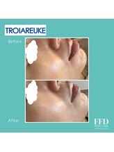 エフエフディースキンケア(FFD SKINCARE)/ピーリング症例