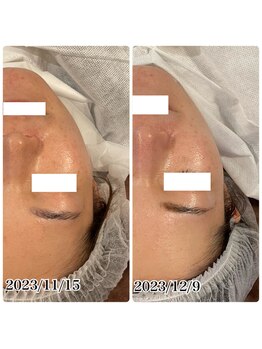 ハーシークレット(Her secret)/ハーブピーリング・くすみケア