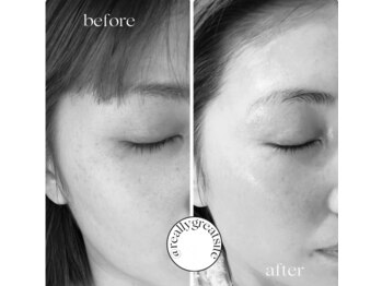 ポエマ(POEMA)/before/after