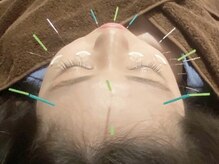 ビビオンリーワン 銀座築地(vivi only one)/美容鍼