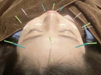 ビビオンリーワン 銀座築地(vivi only one)/美容鍼