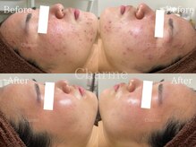 シャルム(Charme.)/陶肌ハーブピーリング(症例写真)