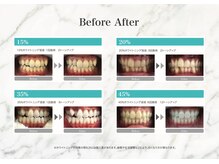 アイディー(Id)/歯科ホワイトニングできます