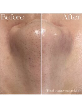 リノ(Lino)/BeforeAfter