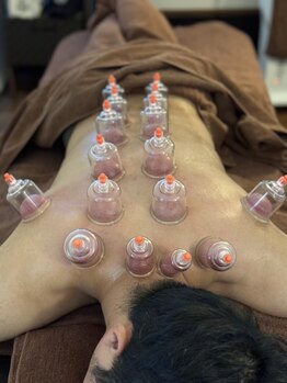 みずわき治療院の写真/《当院大人気の美容鍼*初回特別価格¥3,500→¥1,980》小顔・リフトアップ効果◎むくみ改善!肌のトーンUPも♪