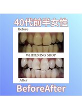 ホワイトニングショップ 西原店/40代前半女性☆BeforeAfter