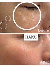 ハクビューティー(HAKU BEAUTY)/40代シミケア/肌質改善