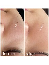 ピュア 川越店/光フェイシャル