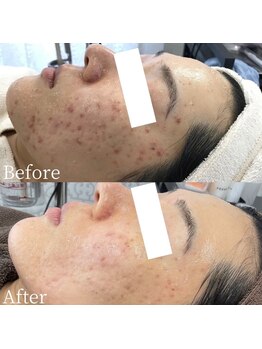 ニキビケア研究所 所沢店/繰り返すニキビでお悩みの方へ