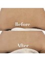 レ ベージュ(L’Beige)&nbsp;背中は脱毛回数がかかる場所です。早めに始めるのがオススメです