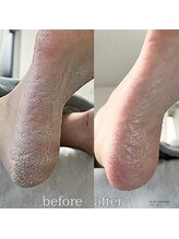 フットミー(foot mii)/初回のビフォーアフター