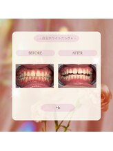 プラスビー 2号店(+b)/ホワイトニングビフォーアフター