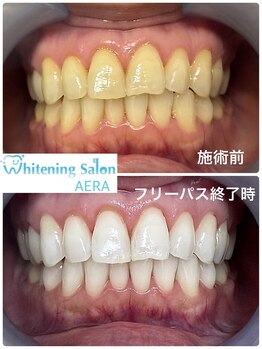 アエラ(AERA)/【ホワイトニングで理想の白さ】