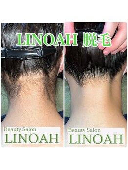 ビューティーサロン リノア(LINOAH)/◎結果重視◎【うなじ脱毛】