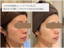 レイテノール 藤沢店/ワントーン上の透明感素肌！