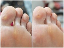 ピアシェ(Piache)/魚の目ケア