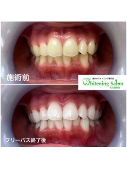 ホワイトニングサロン 名古屋駅店/【ホワイトニング施術例】