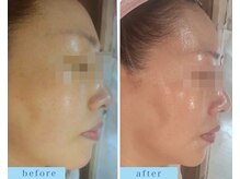 アフロディーテ(APHRODITE)/ビフォーアフター