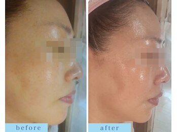 アフロディーテ(APHRODITE)/ビフォーアフター