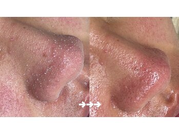 フロラスキン 銀座Miel店(florasKIN)/毛穴洗浄コース