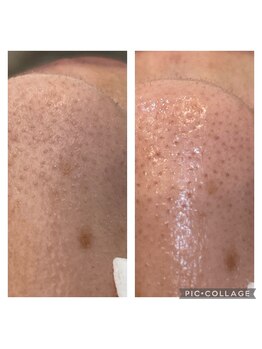 ルナート(Lunart)/毛穴洗浄/毛穴ケア