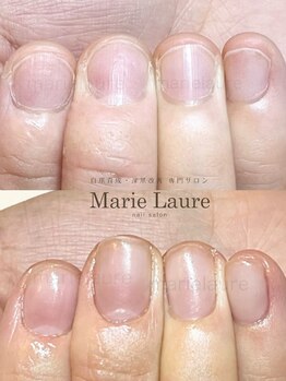 マリーロール 梅田店(Marie Laure)/自爪育成/深爪矯正/ネイルケア