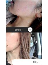 エスボーテ(sbeaute)/赤み、皮膚のバリア機能強化