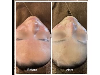 ルナート(Lunart)/ハーブピーリング【顔】