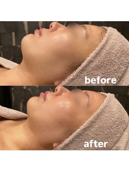 ビュウナ 銀座(BEAUNA)/カルテットモード半顔