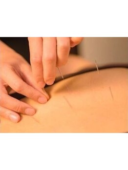 鍼灸施術を受けたい
