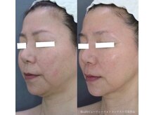 ビューティーサロン アンジュエール/エンダモリフトフェイシャル☆