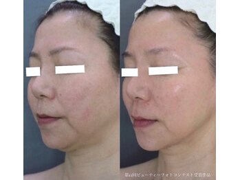 ビューティーサロン アンジュエール/エンダモリフトフェイシャル☆