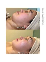 サロン ド ブラン アオヤマ(Salon de BLANC AOYAMA)/ビオフィート×ソノケア70分